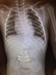 carson post hemi excision and fusion xray